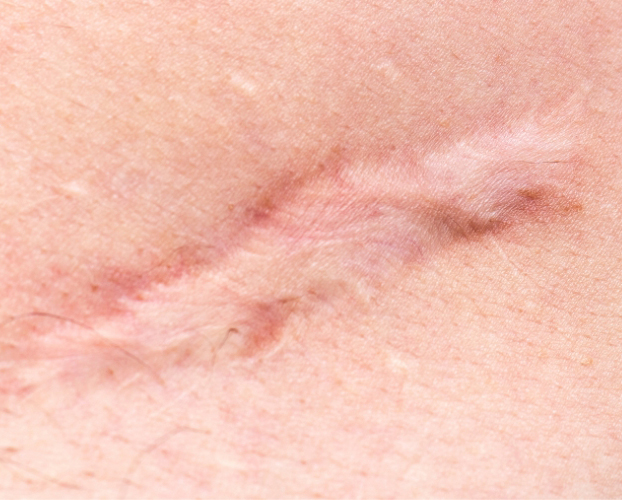Trị Sẹo Rỗ Sẹo Lõm Bằng Laser Tại Sen Beauty